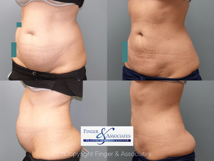 Before and after 3-months of Liposuction on abdomen and hip rolls plus Renuvion for Skin Tightening