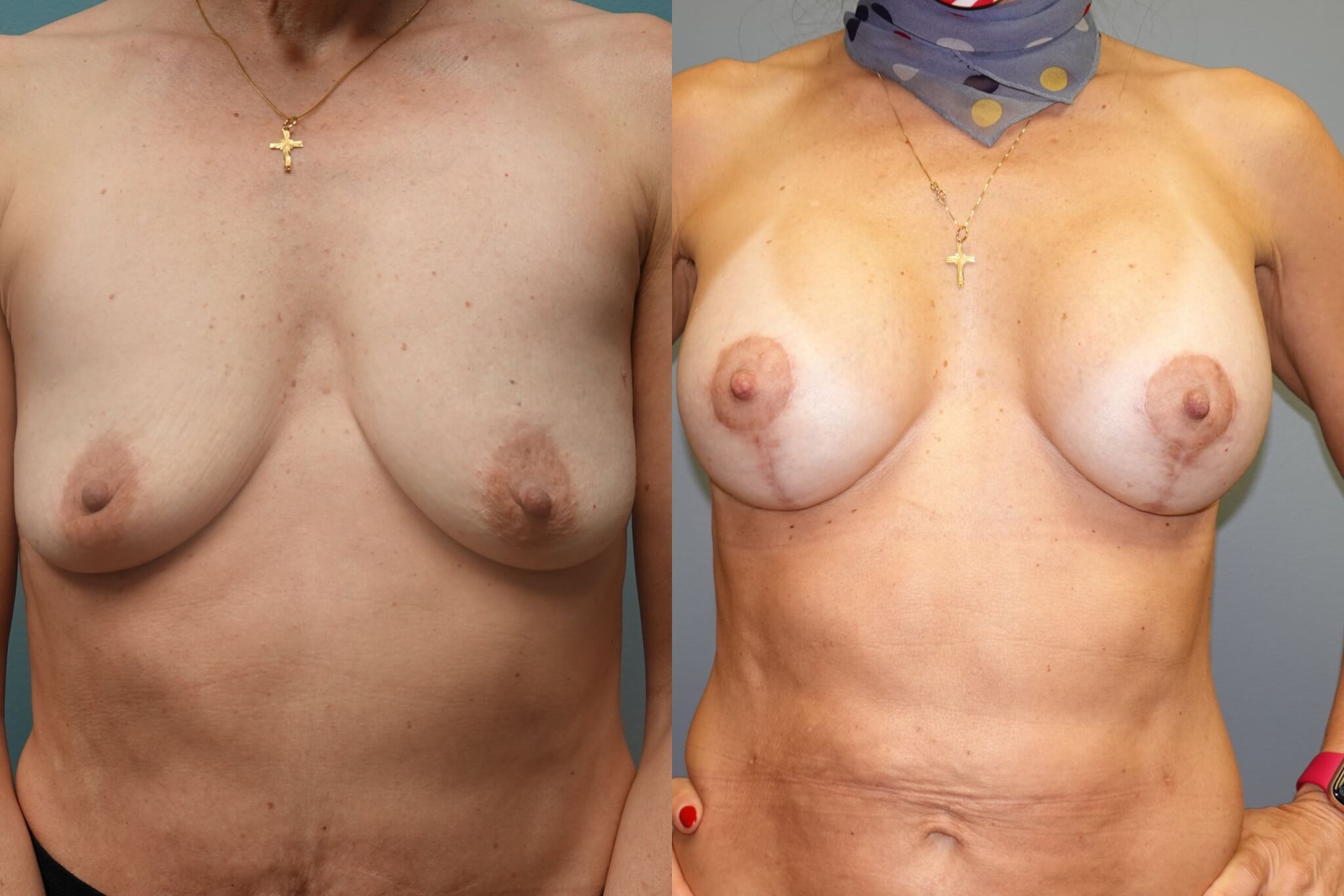 Before and after 11-months of Breast Lift and Breast Augmentation