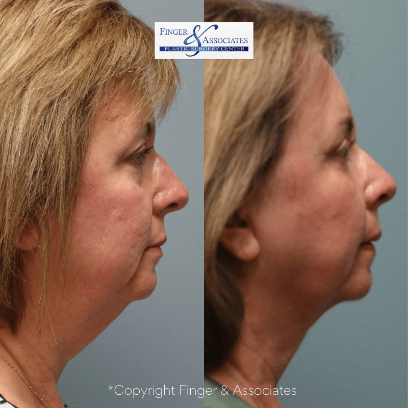 Before and after 12-months of neck Liposuction and Renuvion for skin tightening