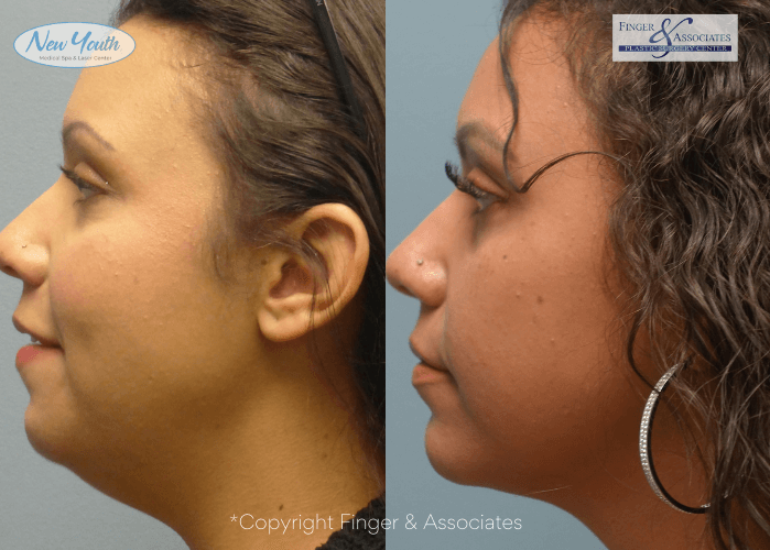 Before and after Renuvion and liposuction of the lower face and neck