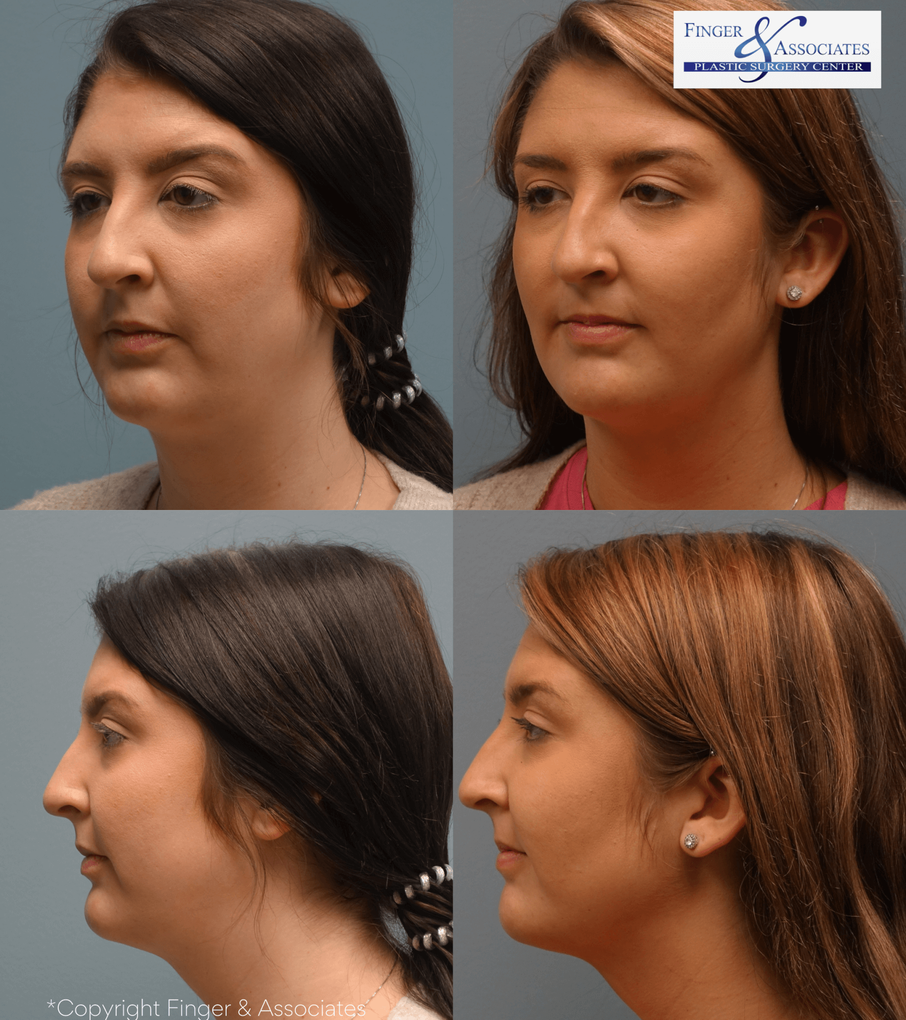 Before and after 6-month of liposuction of the lower face and neck
