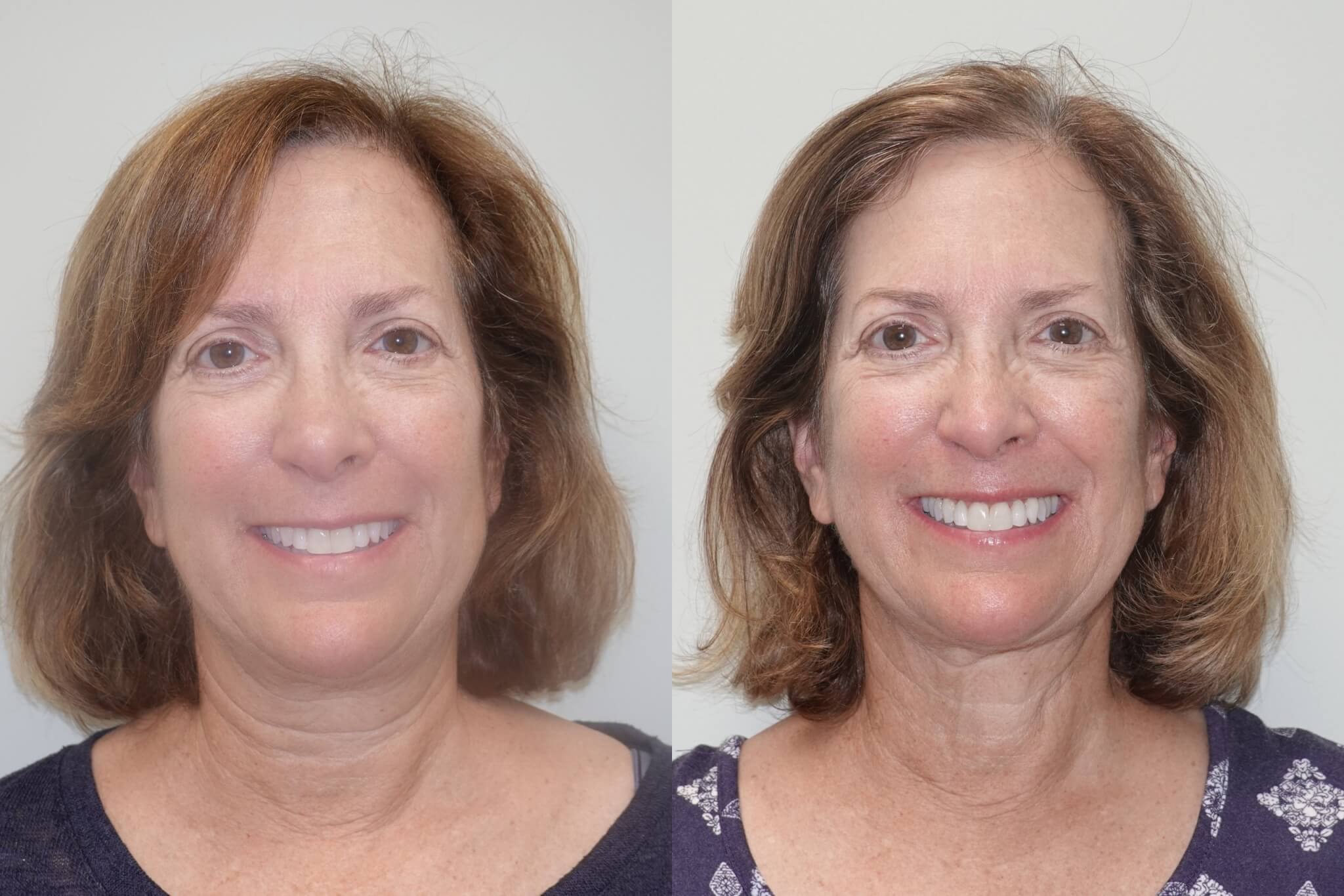 Before and after 6-months liposuction of the lower face and neck and Renuvion
