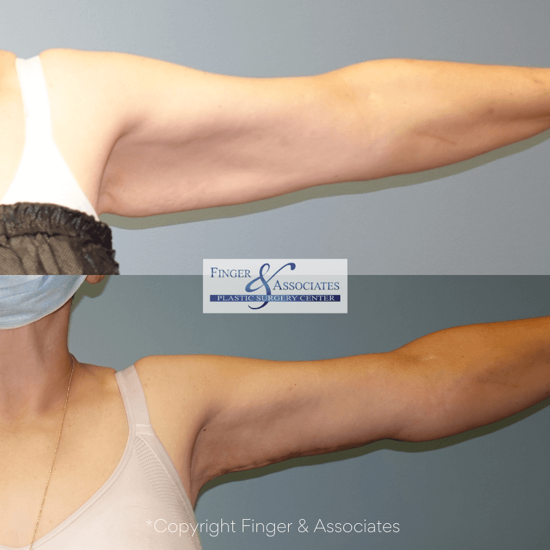 Before and after liposuction of the arms and arm lift (brachioplasty