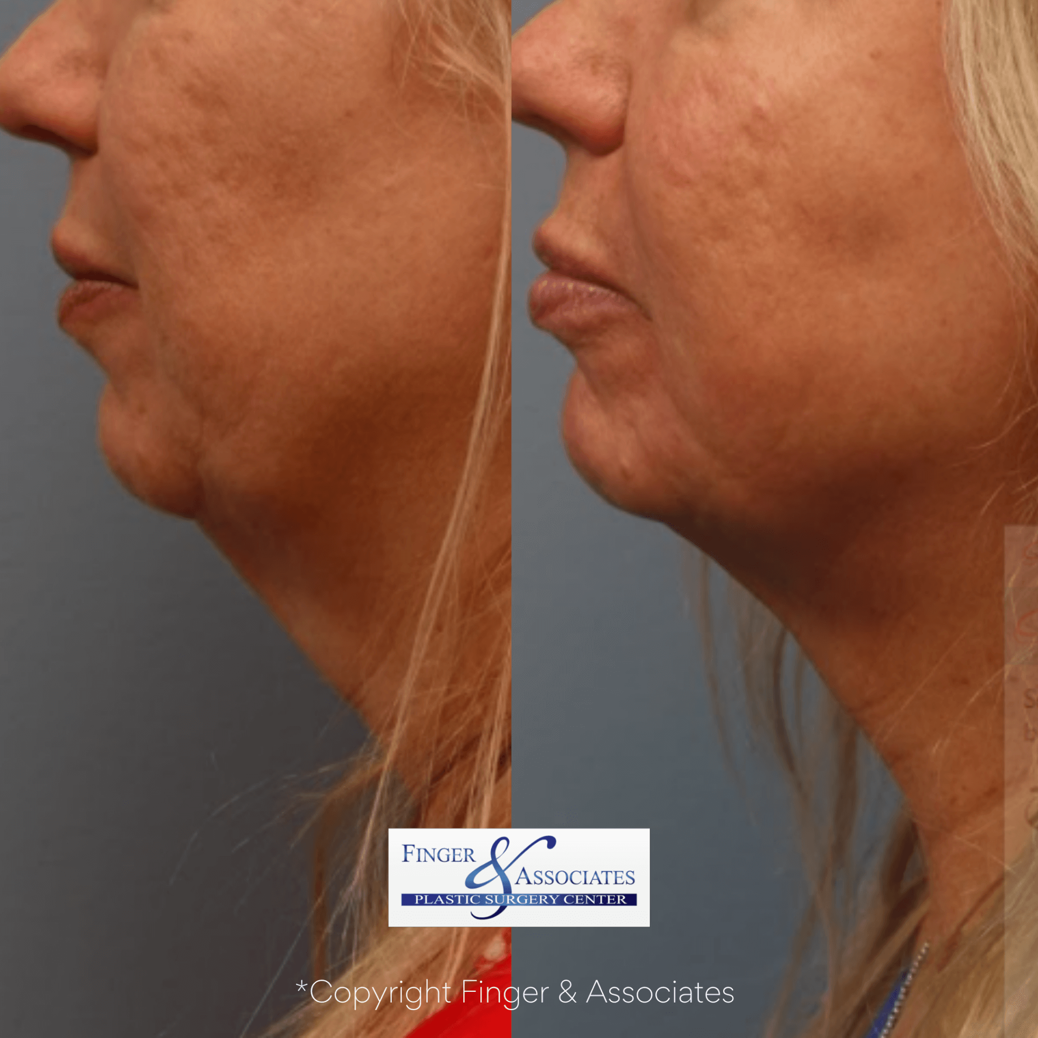 Before and after neck iposuction and thermitight for skin tightening
