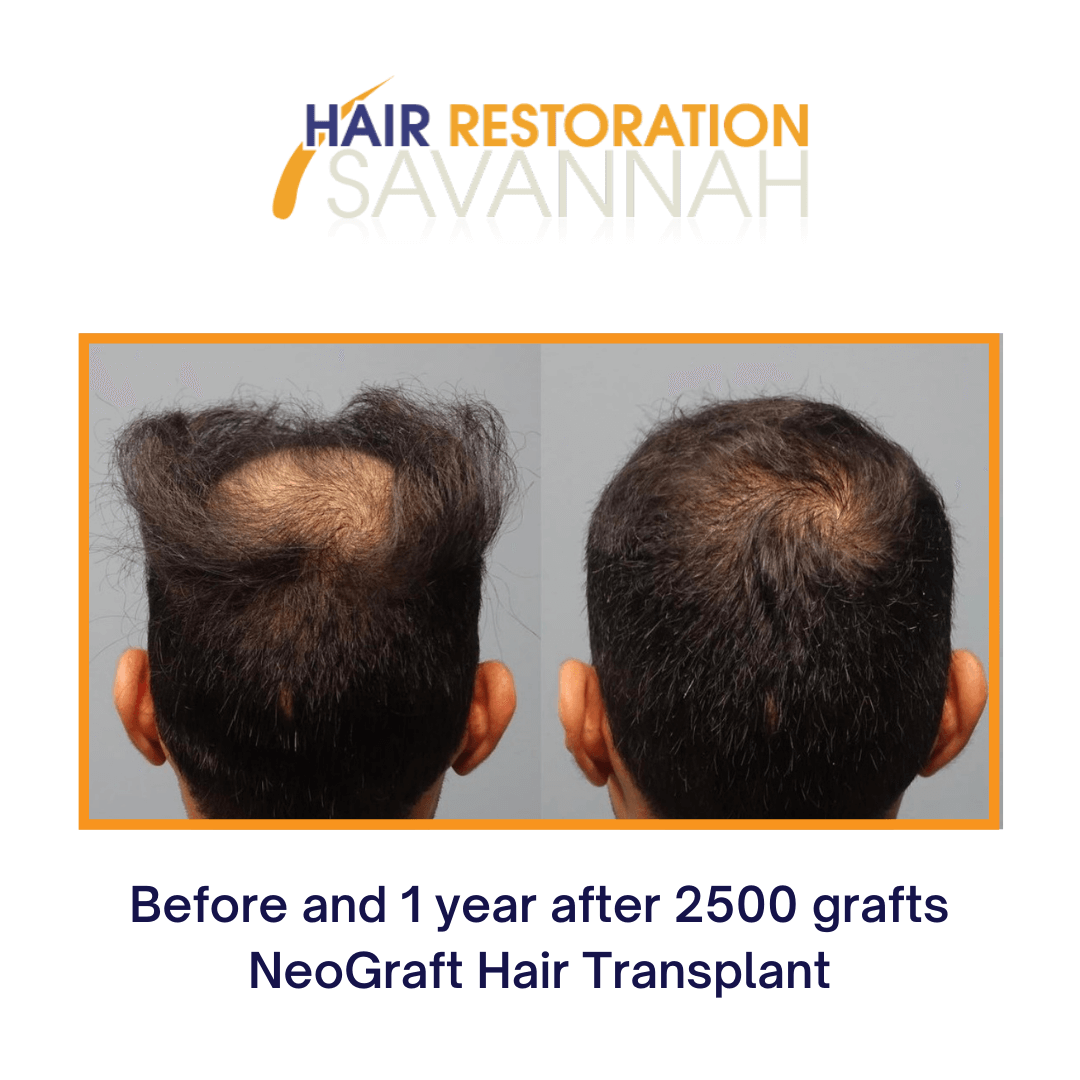 Before and after one year of receiving NeoGraft Hair Restoration