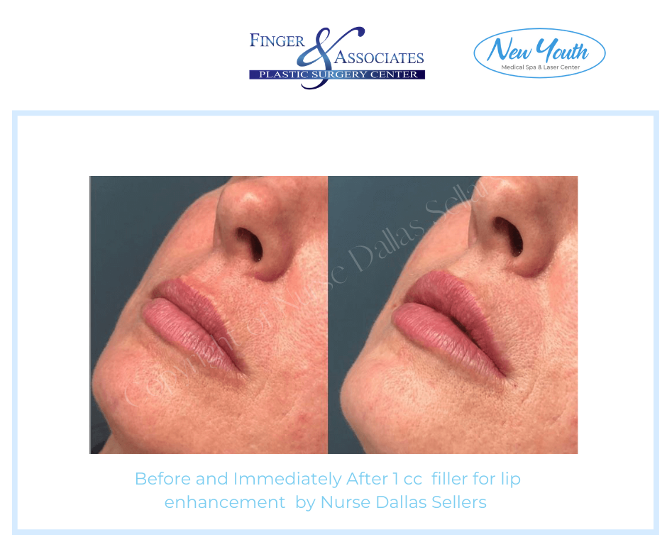 lip fillers by Dallas before and after