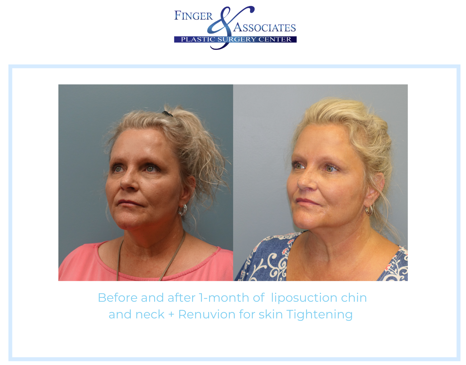 Before and after Renuvion + Lipo by Dr. Finger in Savannah