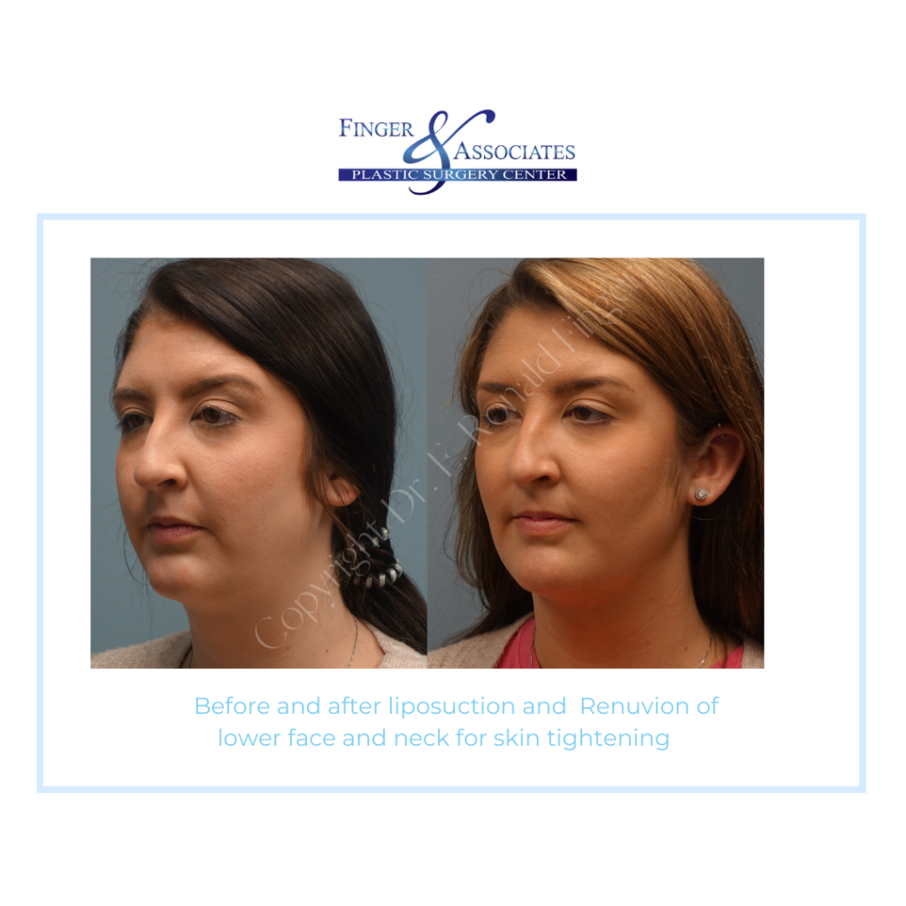 Before and After Liposuction and Renuvion of lower face and neck for Skin Tightening