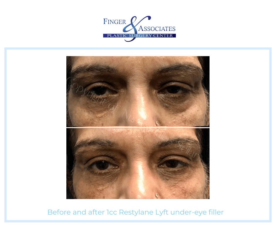 Before and after 1cc Restylane Lyft under-eye filler By Dallas Sellars 