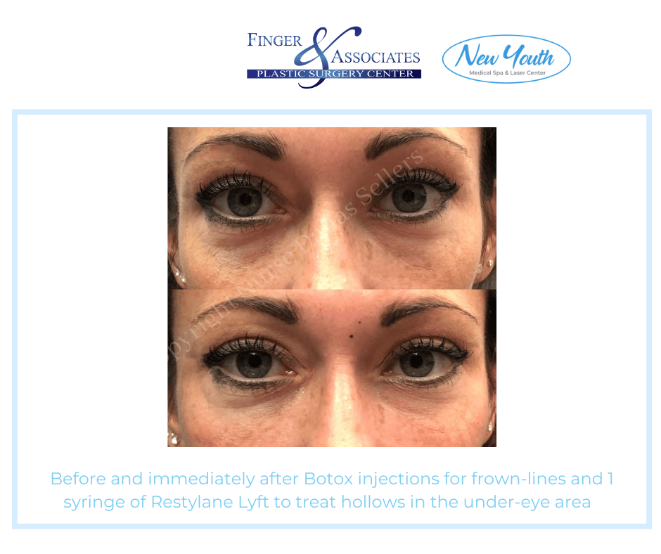 Before and after under eye filler by Dallas Sellars