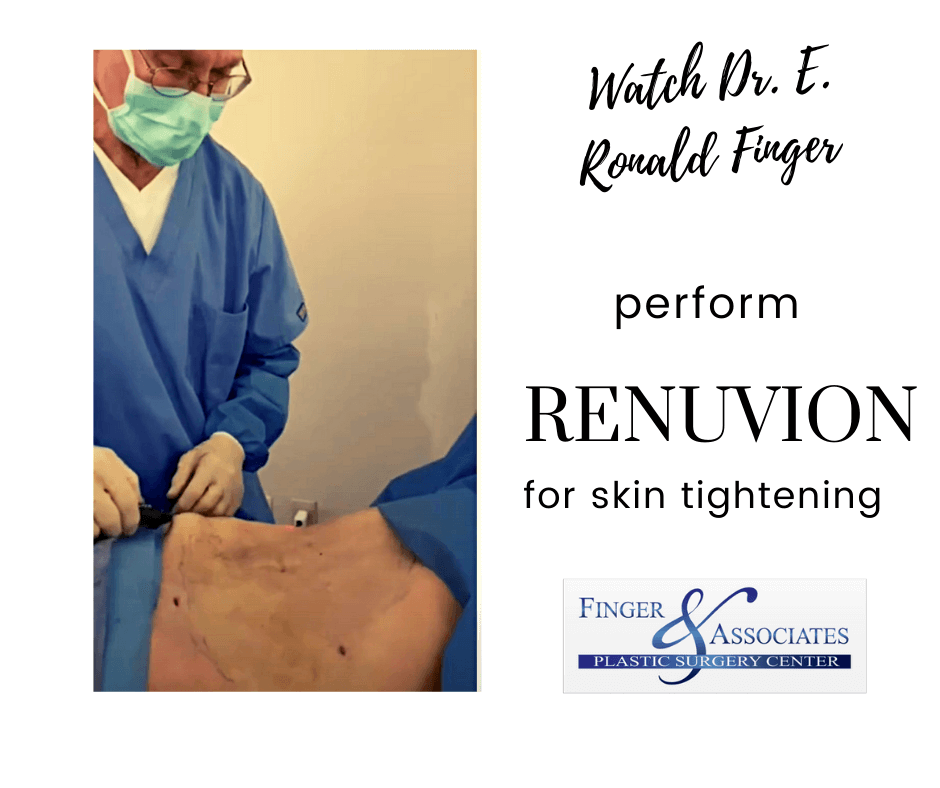 Dr. Finger goes below the skin to use Renuvion