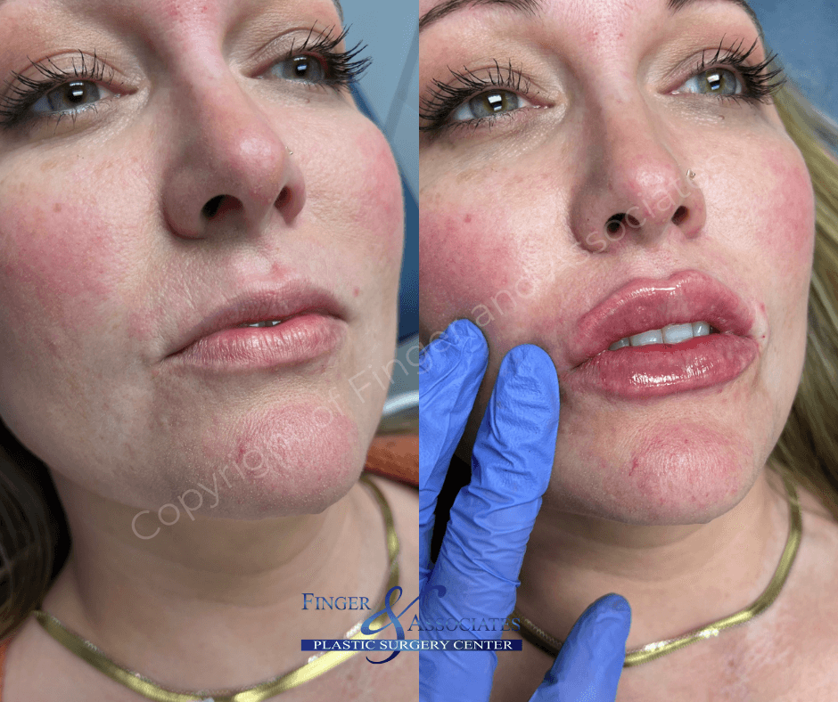 Before and immediately after Lip Filler by Nurse Dallas Sellars 