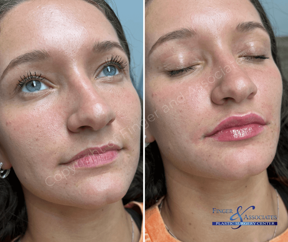 Before and after Versa Lip Filler