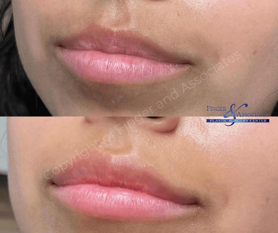 Before and after Versa Lip Filler by Nurse Dallas