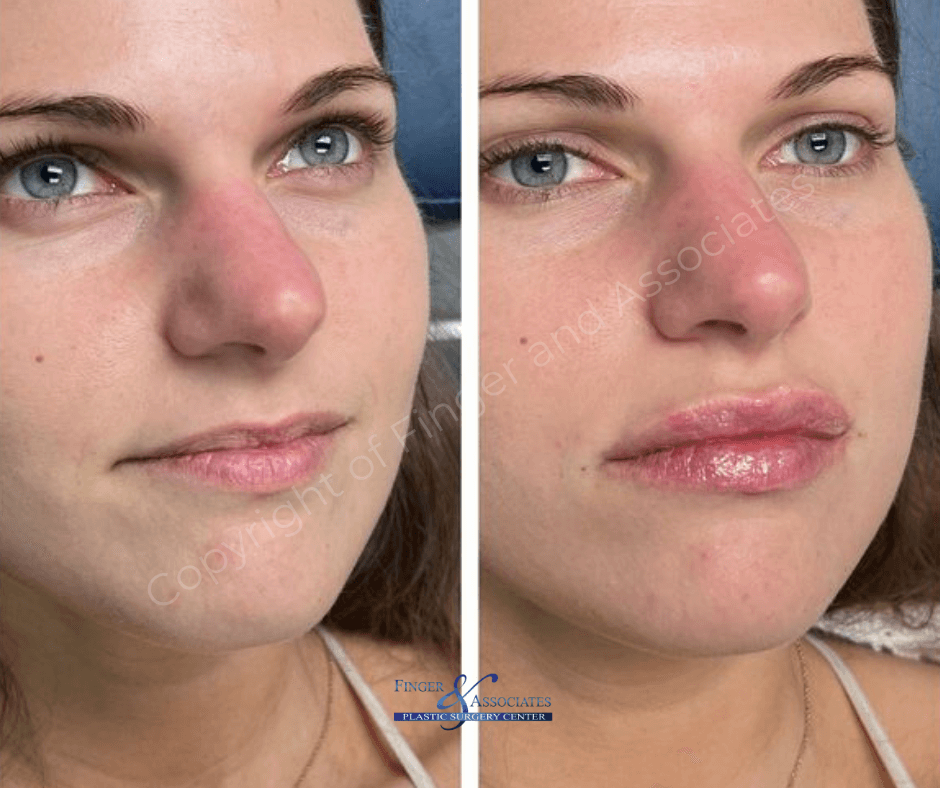 Before and after Versa Lip Filler by Nurse Dallas- Finger and Associates