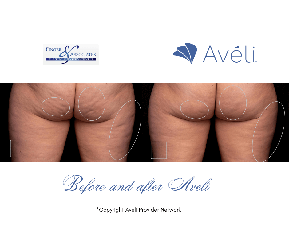 The Science behind Aveli to treat Cellulite - Before and after Aveli