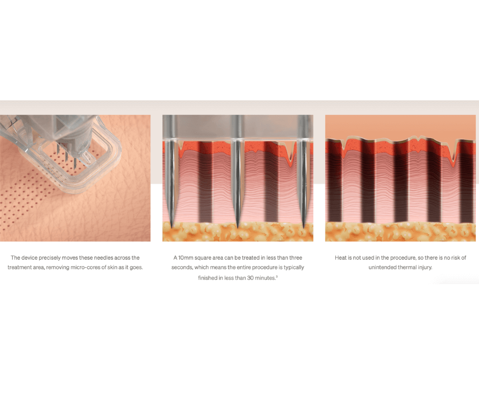 How it Works. Ellacor uses hollow needles to remove micro-cores of skin, resulting in an improved appearance of moderate and severe wrinkles in the mid and lower face without the evidence of scarring.1,2