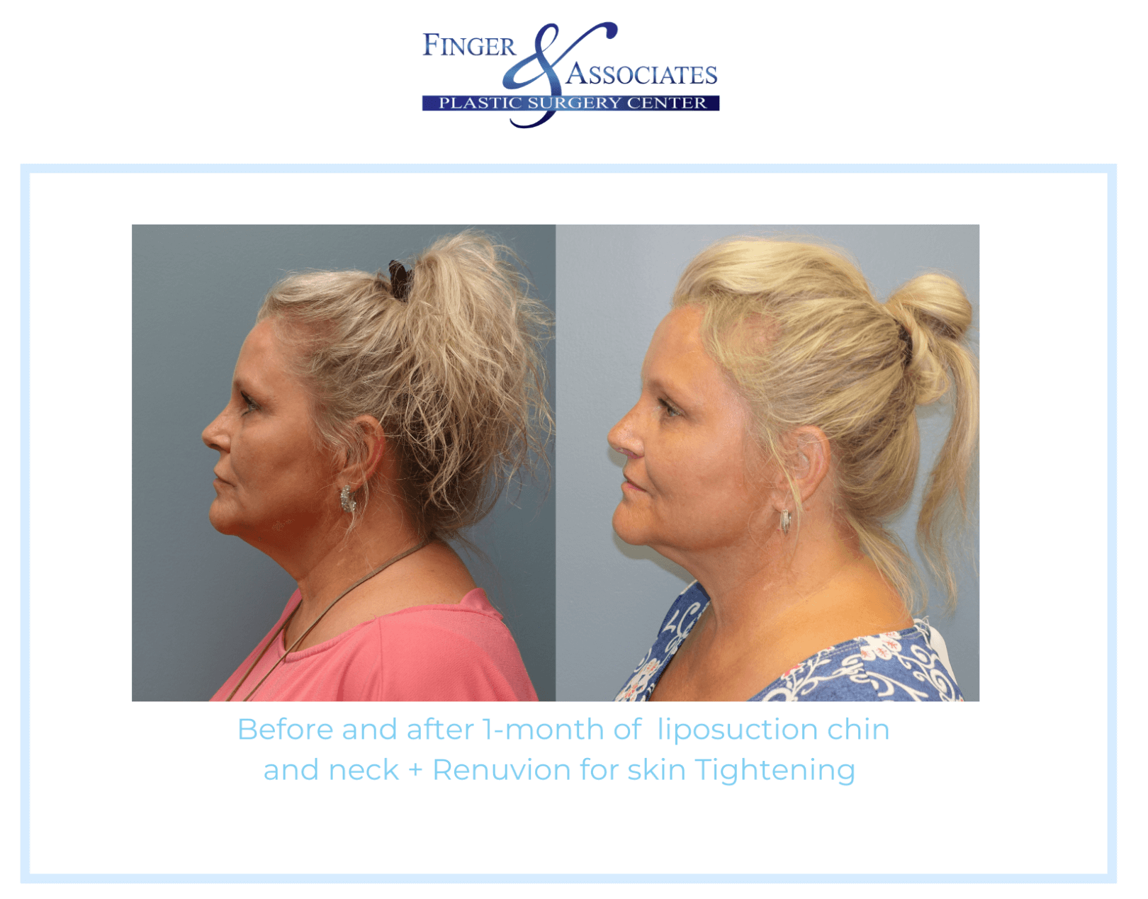 Before and After Liposuction Chin and neck + Renuvion for Skin Tightening