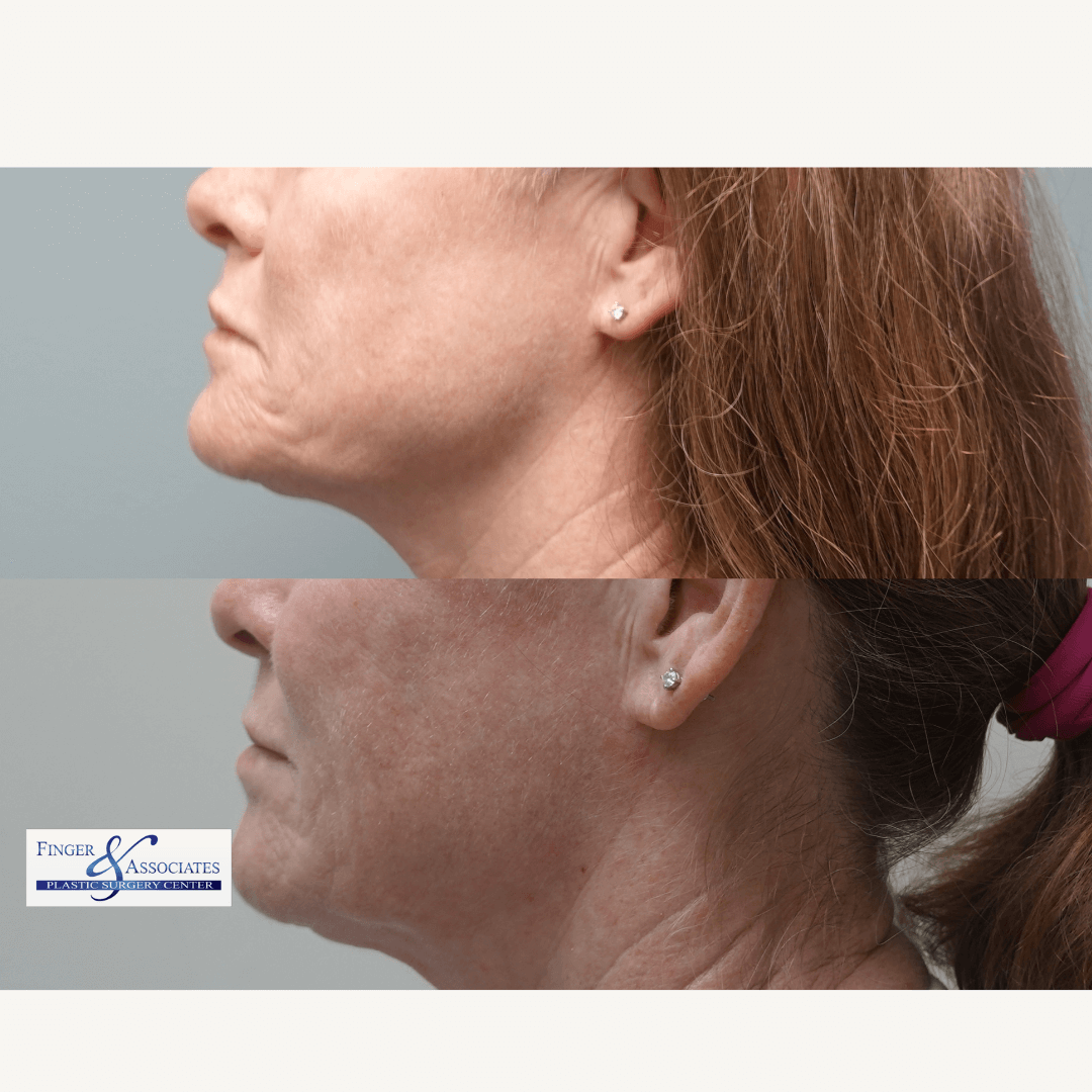 Before and After 2 months of receiving Ellacor for Skin tightening of the face by Dr Finger