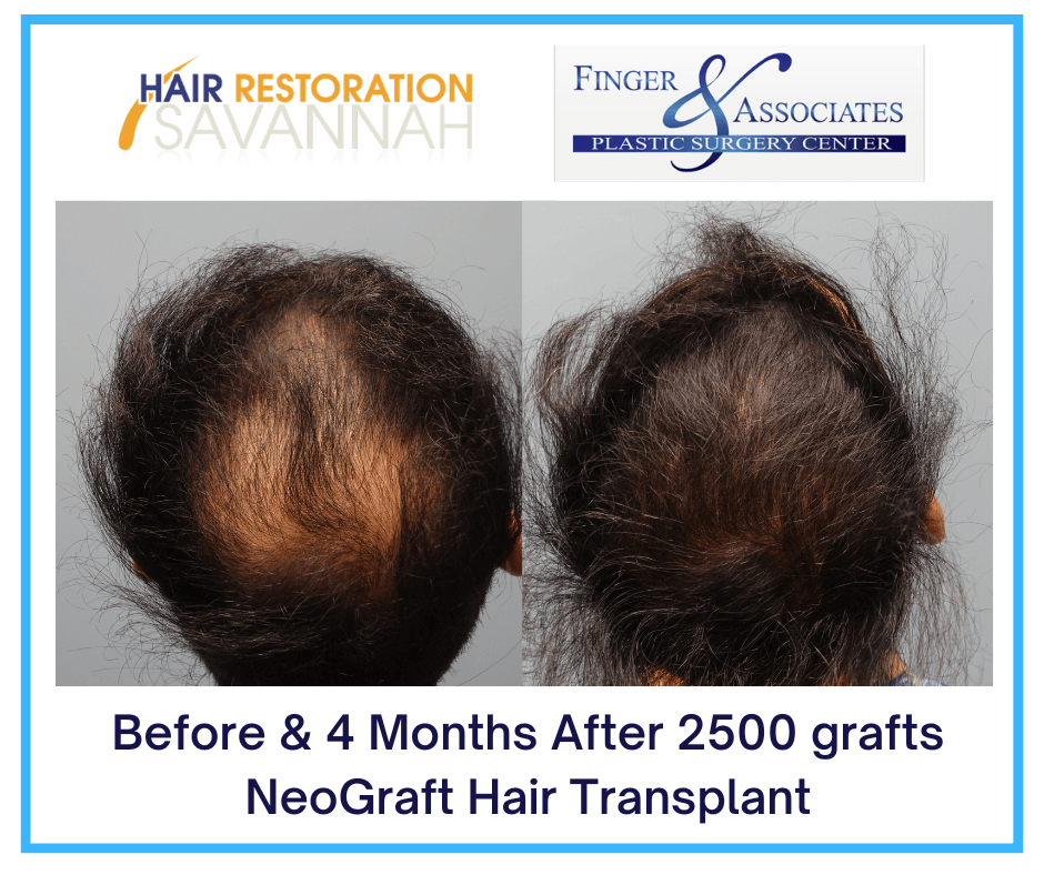 Before & 4 Months After 2500 grafts NeoGraft Hair Transplant Before & 4 Months After 2500 grafts NeoGraft Hair Transplant.