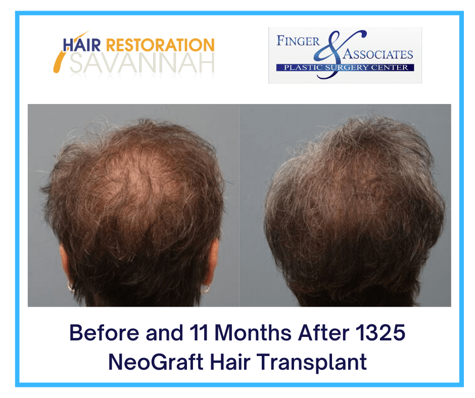 Before and 11 Months After 1325 NeoGraft Hair Transplant Before and 11 Months After 1325 NeoGraft Hair Transplant.