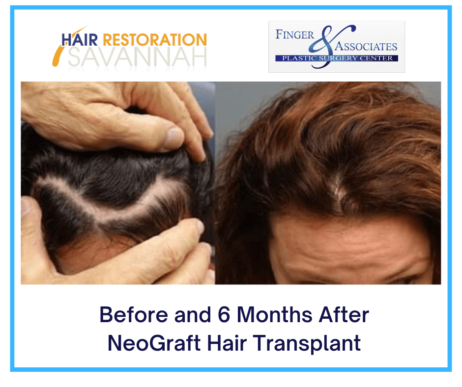 Before-and-6-Months-After-NeoGraft-Transplant
