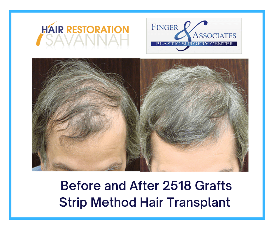Before and After 2518 Grafts Strip Method Hair Transplant -3 Before and After 2518 Grafts Strip Method Hair Transplant