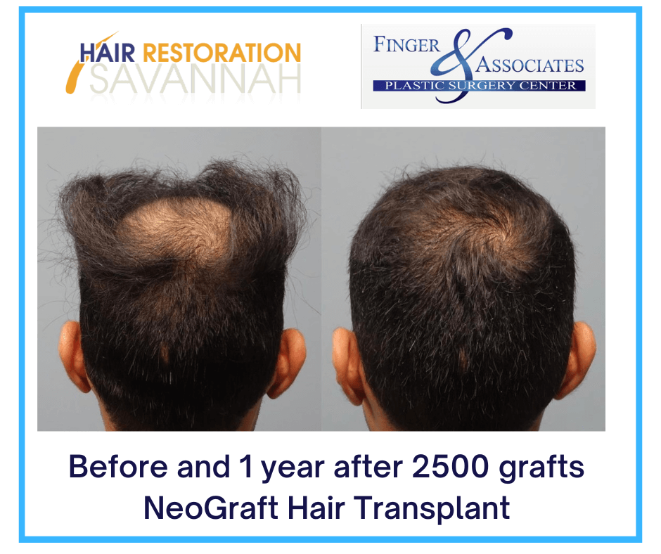 Before & After Hair Restoration with Hair Restoration Savannah (Facebook Post) Before & After Neograft HairTransplant At Finger and Associates
