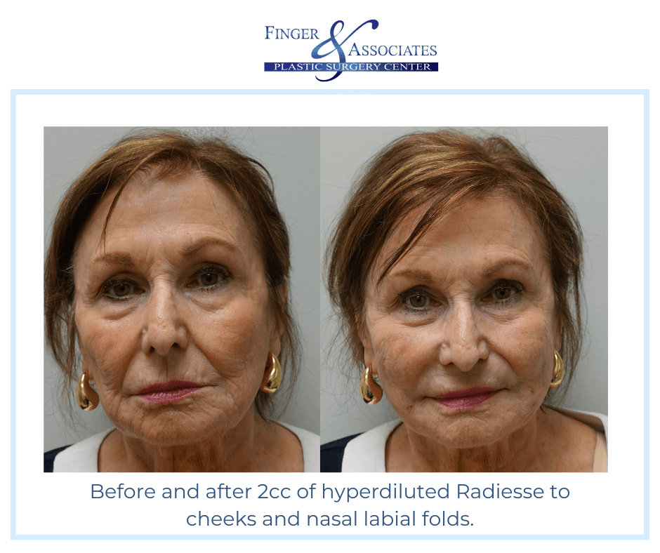 Before and after 2cc of hyperdiluted Radiesse to cheeks and nasal labial folds.