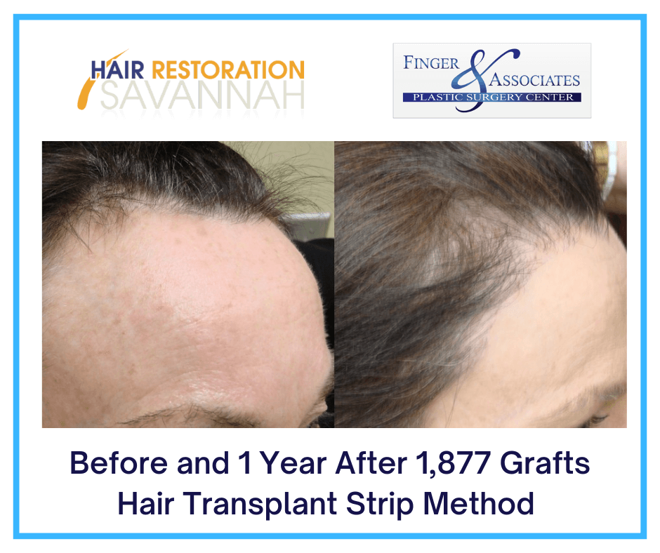 Before and 1 Year After 1,877 Grafts Hair Transplant Strip Method