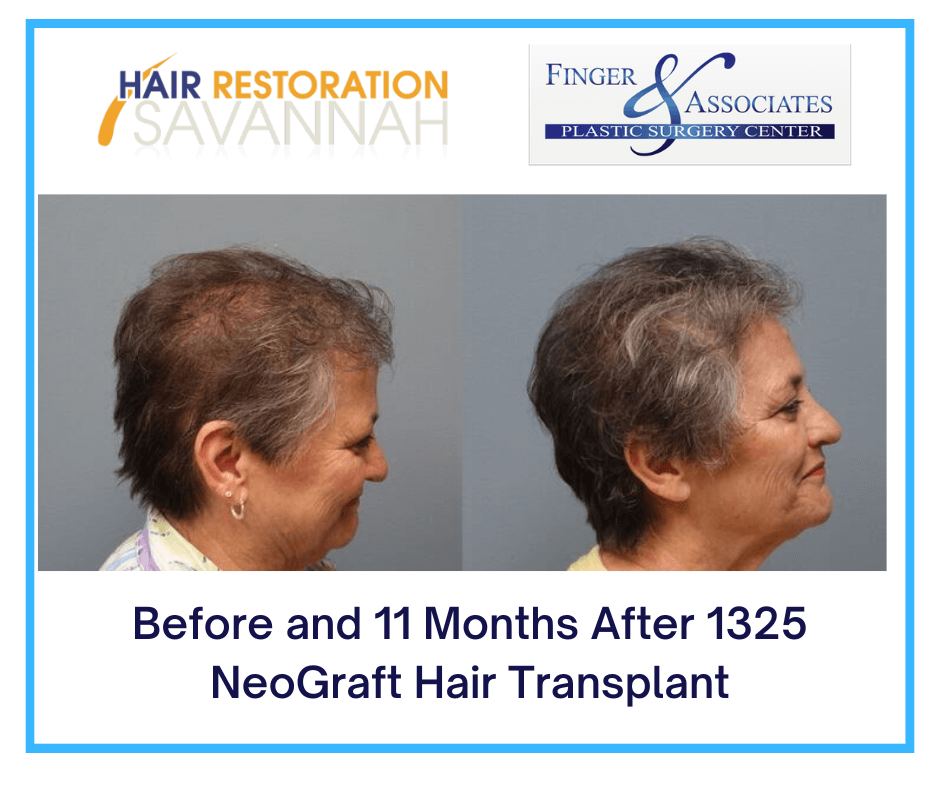 Before and 11 Months After 1325 NeoGraft Hair Transplant-2 Before and 11 Months After 1325 NeoGraft Hair Transplant