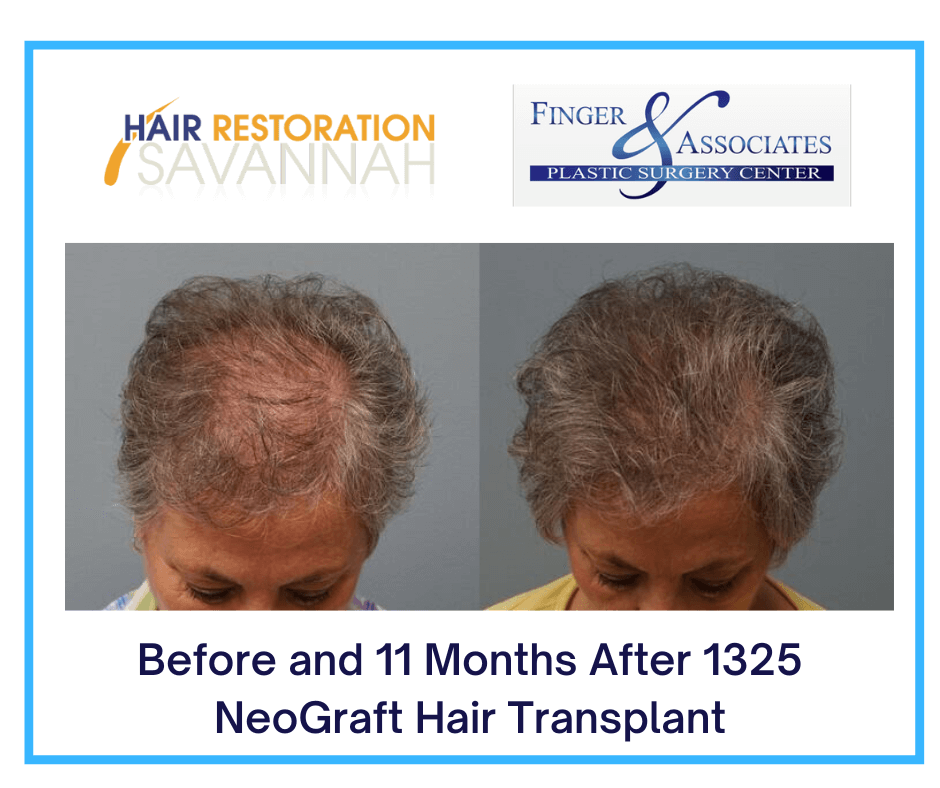 Before and 11 Months After 1325 NeoGraft Hair Transplant Before and 11 Months After 1325 NeoGraft Hair Transplant