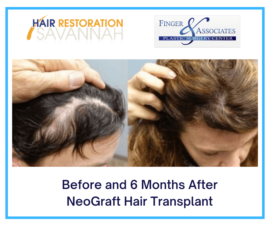Before and 6 Months After NeoGraft Hair Transplant-2 Before and 6 Months After NeoGraft Hair Transplant- Hair Restoration for Women in Savannah