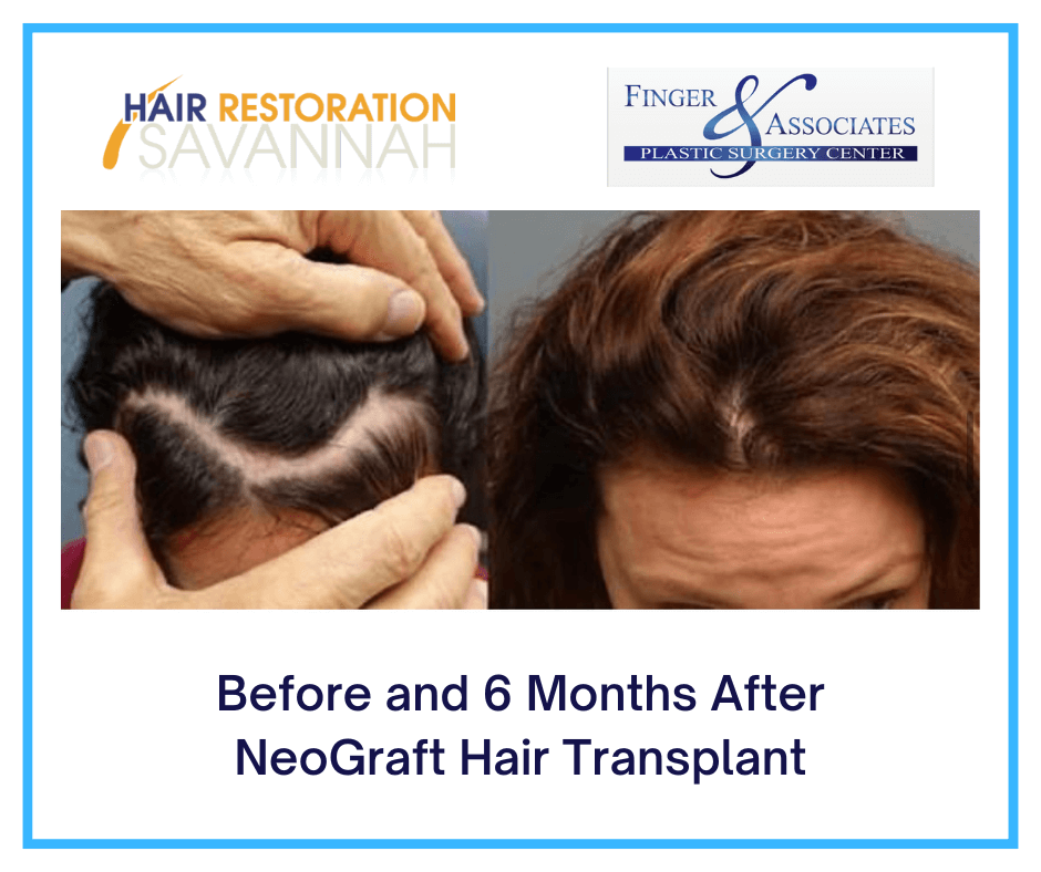 Before and 6 Months After NeoGraft Transplant-2 Before and 6 Months After NeoGraft Hair Transplant