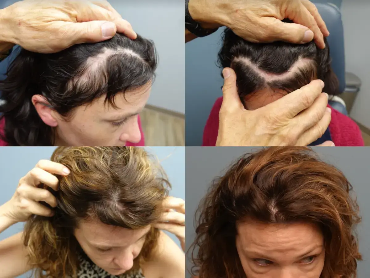 Before and After NeoGraft Transplant of 930 Graft