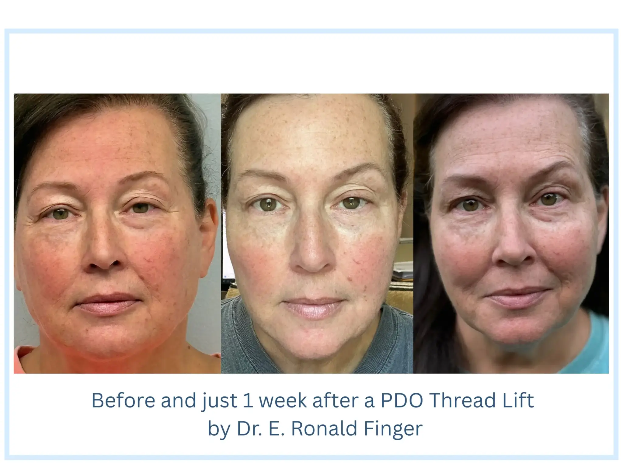 Before and just 1 week after a PDO Thread Lift by Dr. E. Ronald Finger