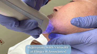 Virtue RF. Microneedling at Finger and Associates Savannah, GA