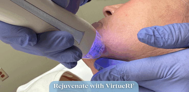 Virtue RF. Microneedling at Finger and Associates Savannah, GA