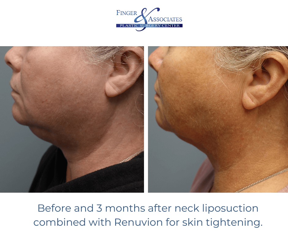 Before and 3 months after neck liposuction combined with Renuvion for skin tightening