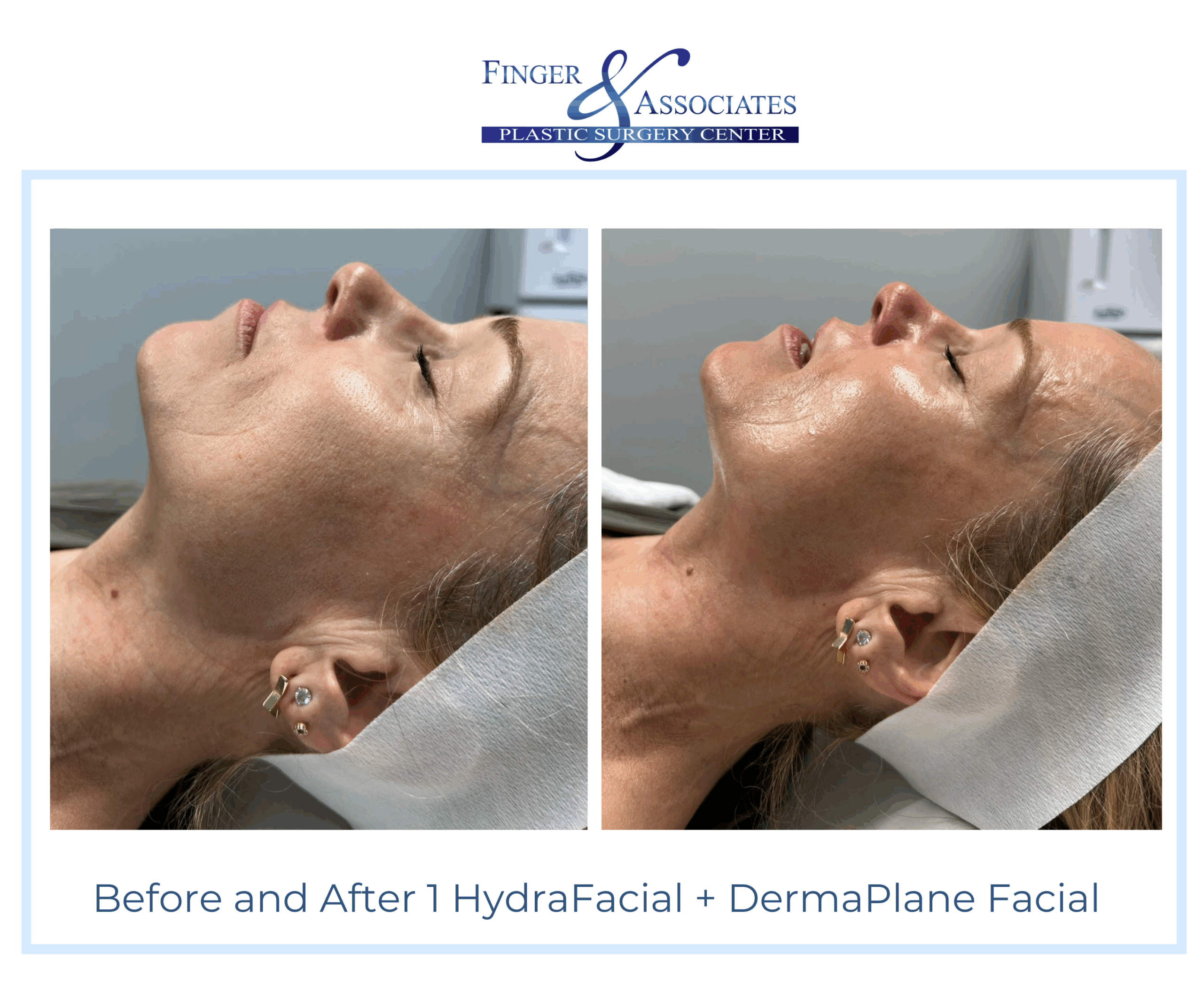 Before and After HydraFacial and DermaPlane by Holly at Finger and Associates Before and After HydraFacial and DermaPlane by Holly at Finger and Associates