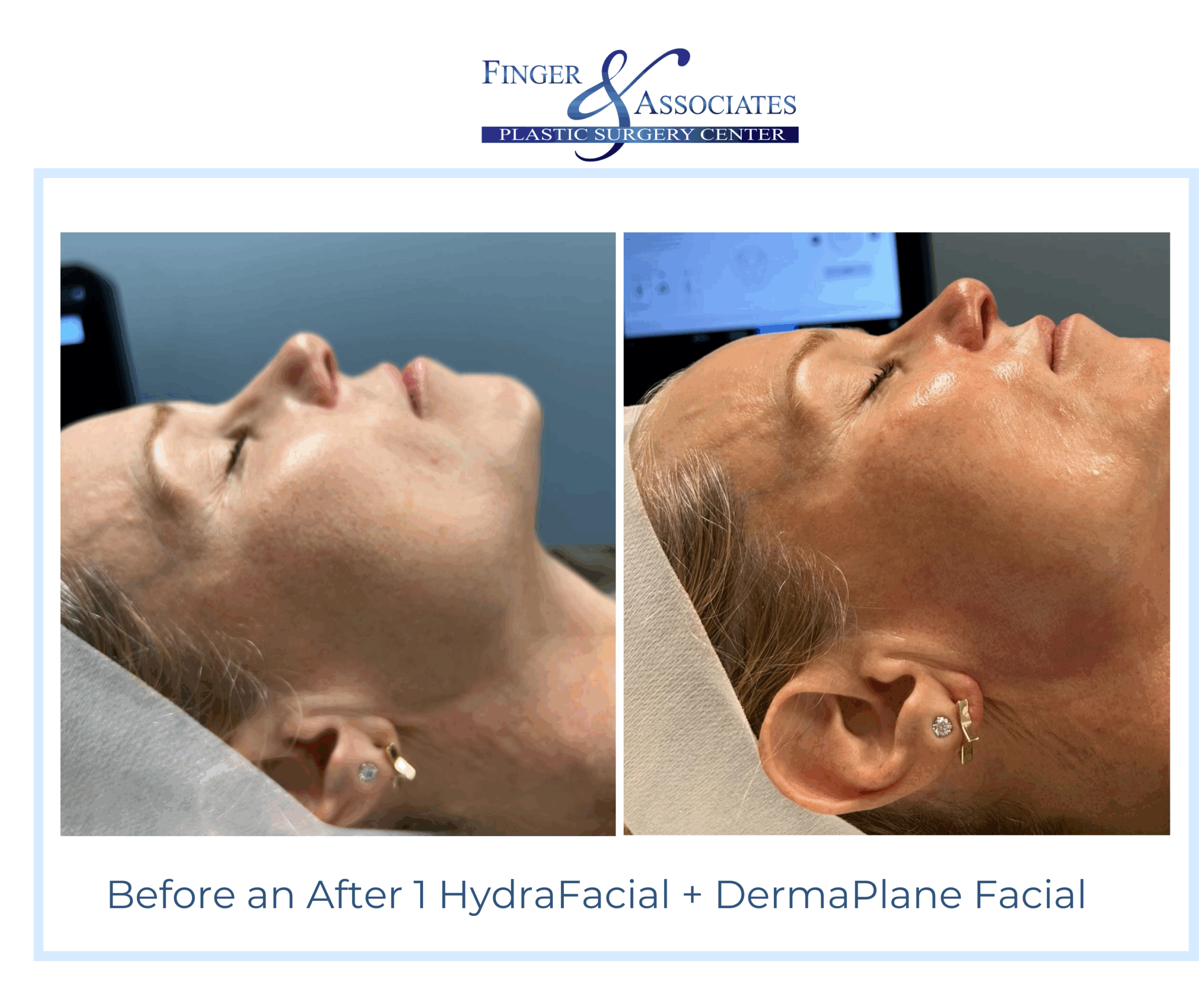 Before and After HydraFacial and DermaPlane by Holly at Finger and Associates (2) Before and After HydraFacial and DermaPlane by Holly at Finger and Associates