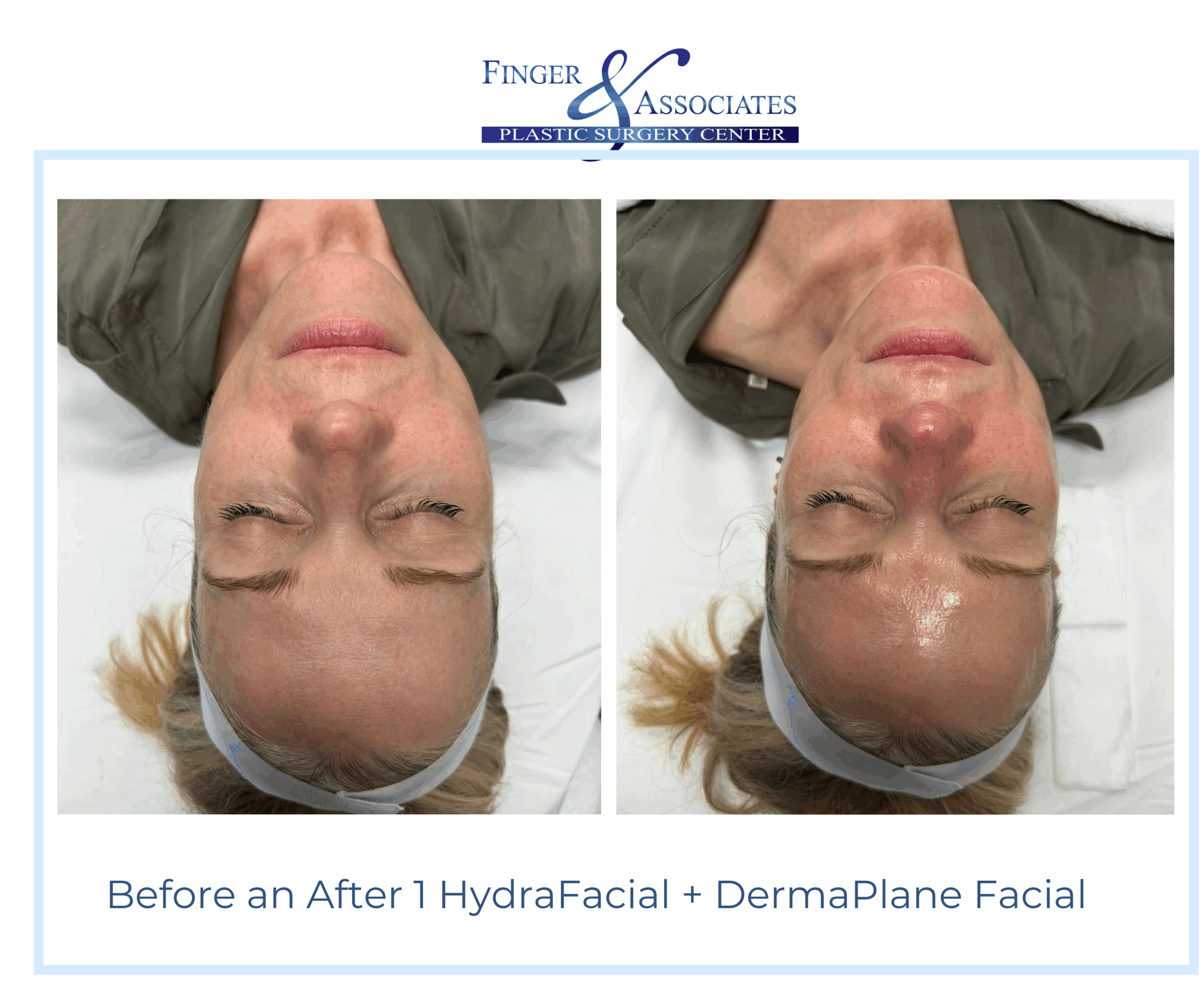 Before and After HydraFacial and DermaPlane by Holly at Finger and Associates (3) Before and After HydraFacial and DermaPlane by Holly at Finger and Associates