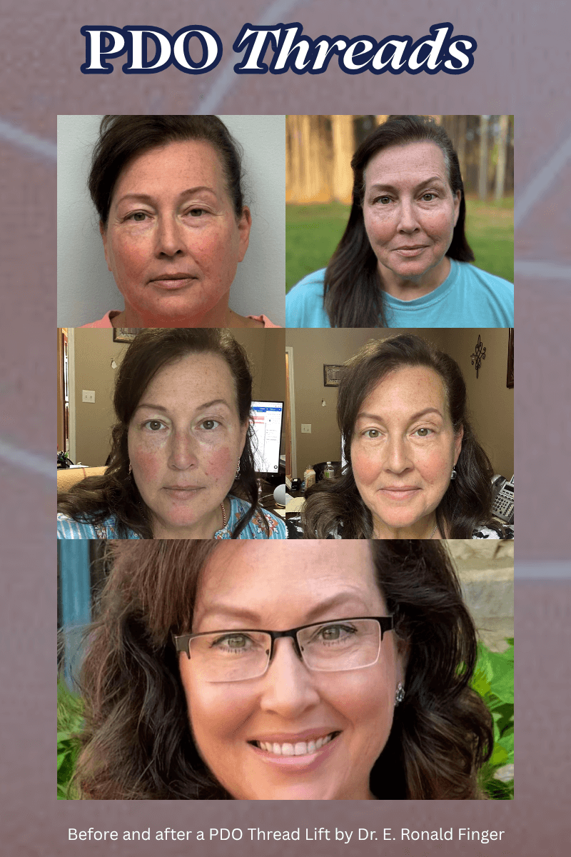 Before and after a PDO Thread Lift by Dr. E. Ronald Finger