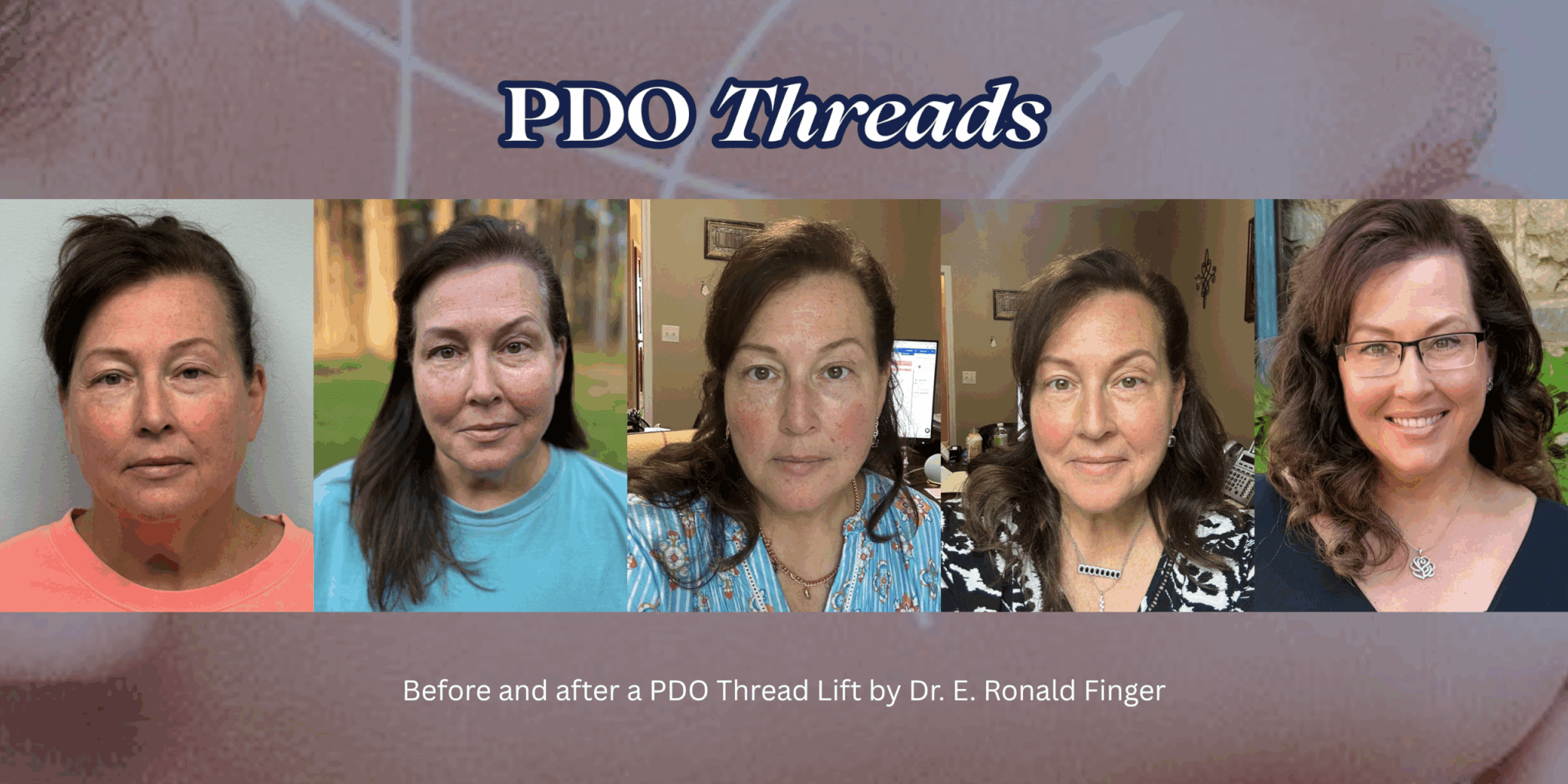 Before and after a PDO Thread Lift by Dr. E. Ronald Finger