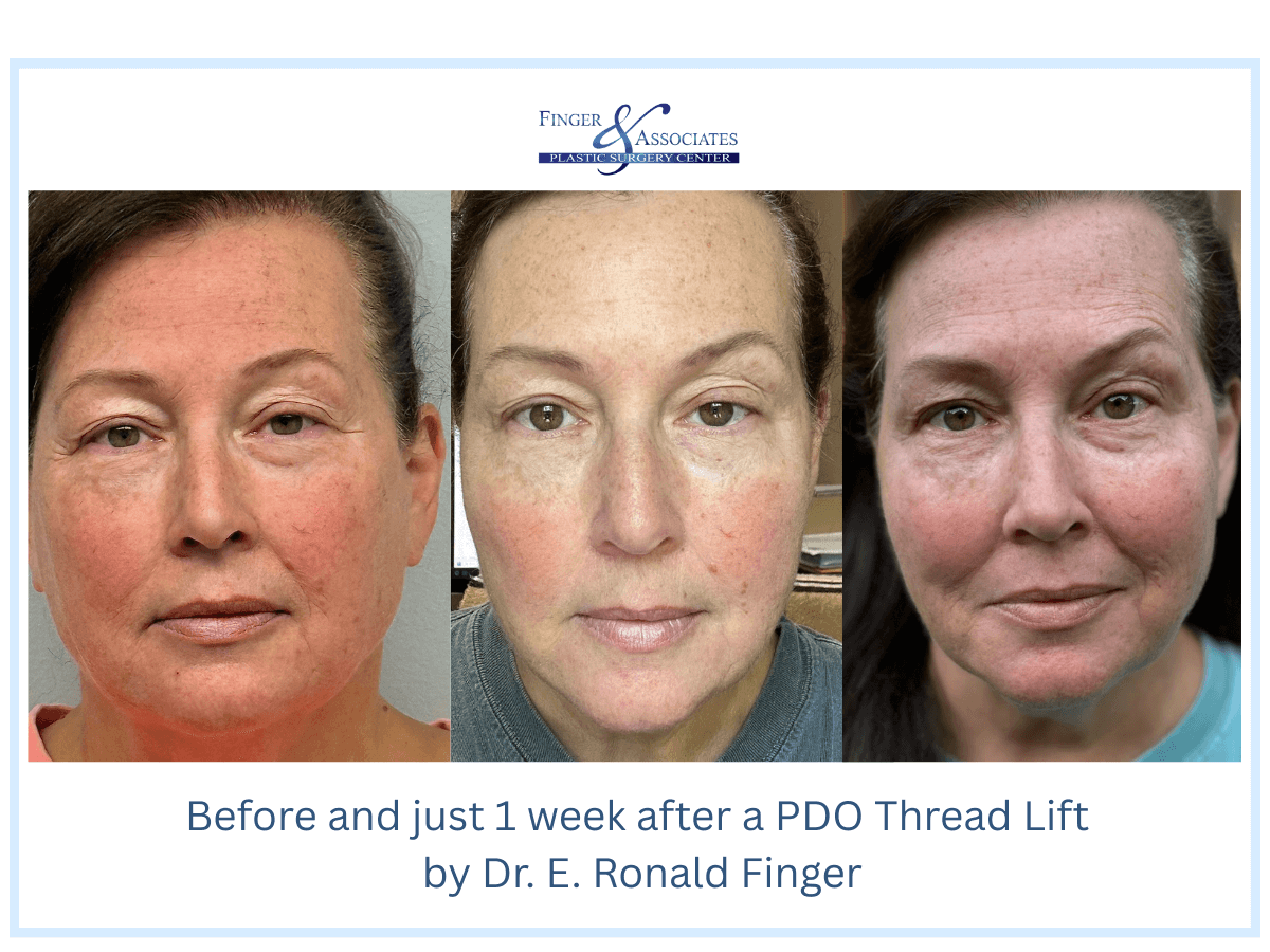 Before and just 1 week after a PDO Thread Lift by Dr. E. Ronald Finger