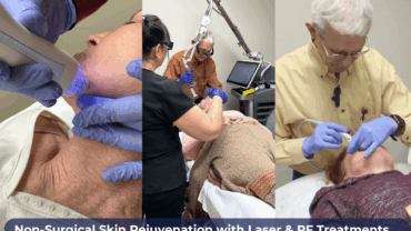 Non Surgical Facial Skin Rejuvenation with Laser & RF Treatments in Savannah, GA