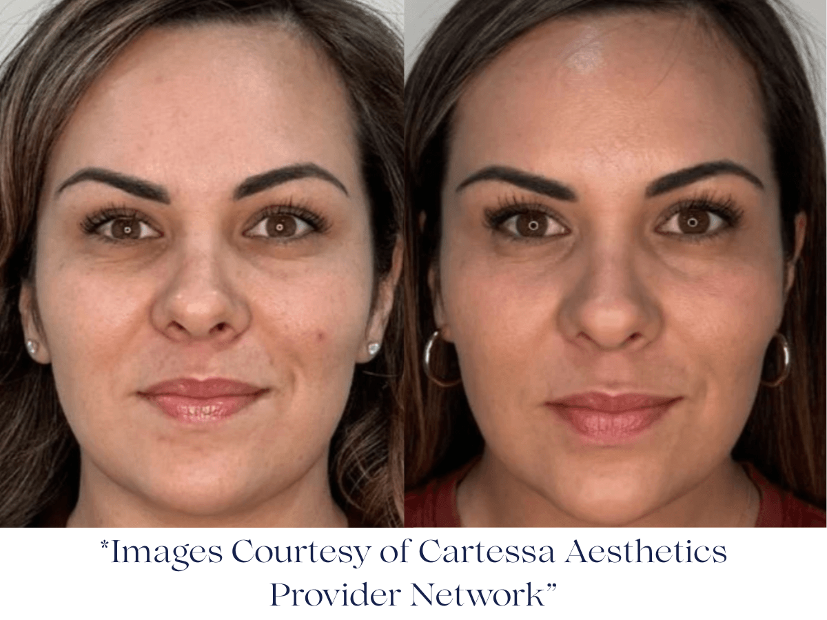 Before and after one Session Everesse RF -Image Courtesy of Cartessa Provider Network Before and after one Session Everesse RF -Image Courtesy of Cartessa Provider Network