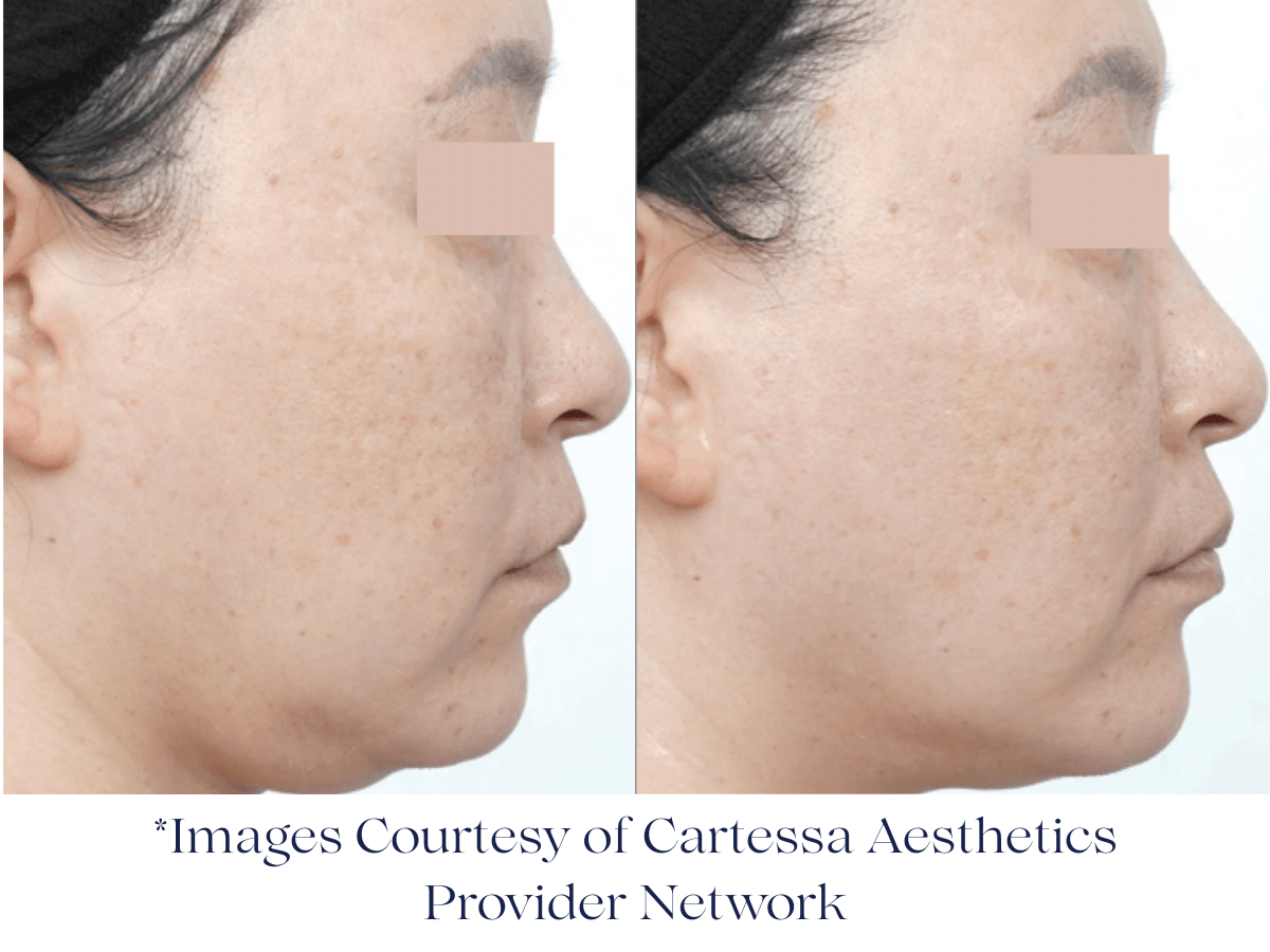 Before and after one Session Everesse RF -Image Courtesy of Cartessa Provider Network Before and after one Session Everesse RF -Image Courtesy of Cartessa Provider Network