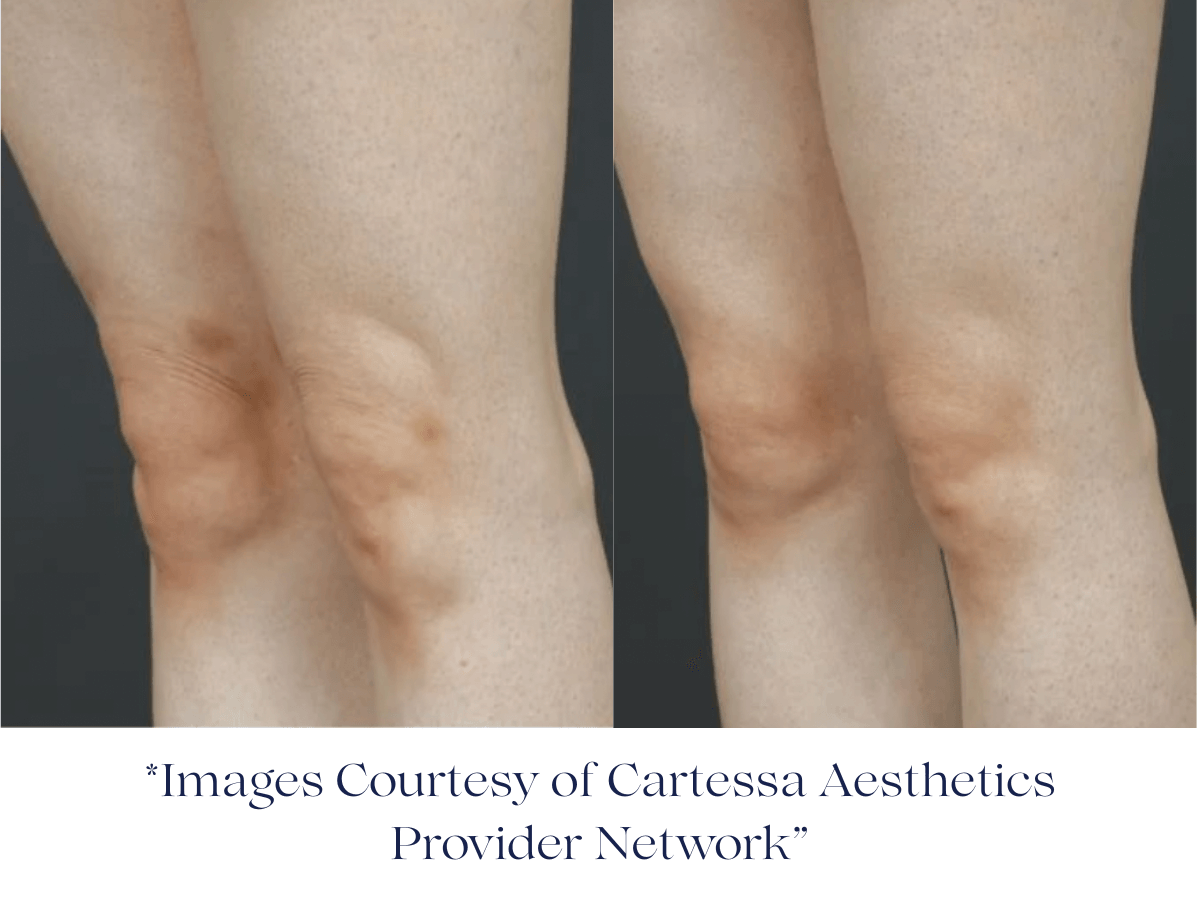 Before and after one Session Everesse RF -Image Courtesy of Cartessa Provider Network Before and after one Session Everesse RF -Image Courtesy of Cartessa Provider Network