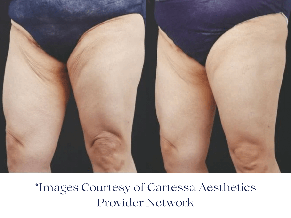 Before and after two Session of Everesse RF -Image Courtesy of Cartessa Provider Network Before and after two Session of Everesse RF -Image Courtesy of Cartessa Provider Network